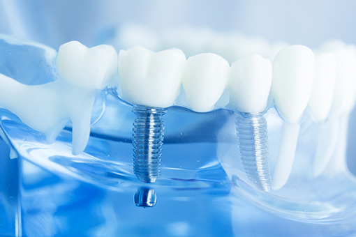 インプラントのイメージ